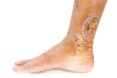 Venous ulcers change from a chronic wound to a common wound, allowing for rapid healing.