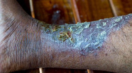 The harm of venous leg ulcers